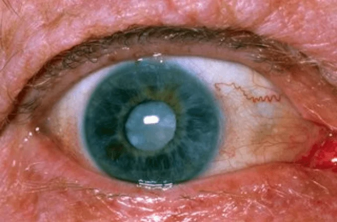 Cataract specialist near me