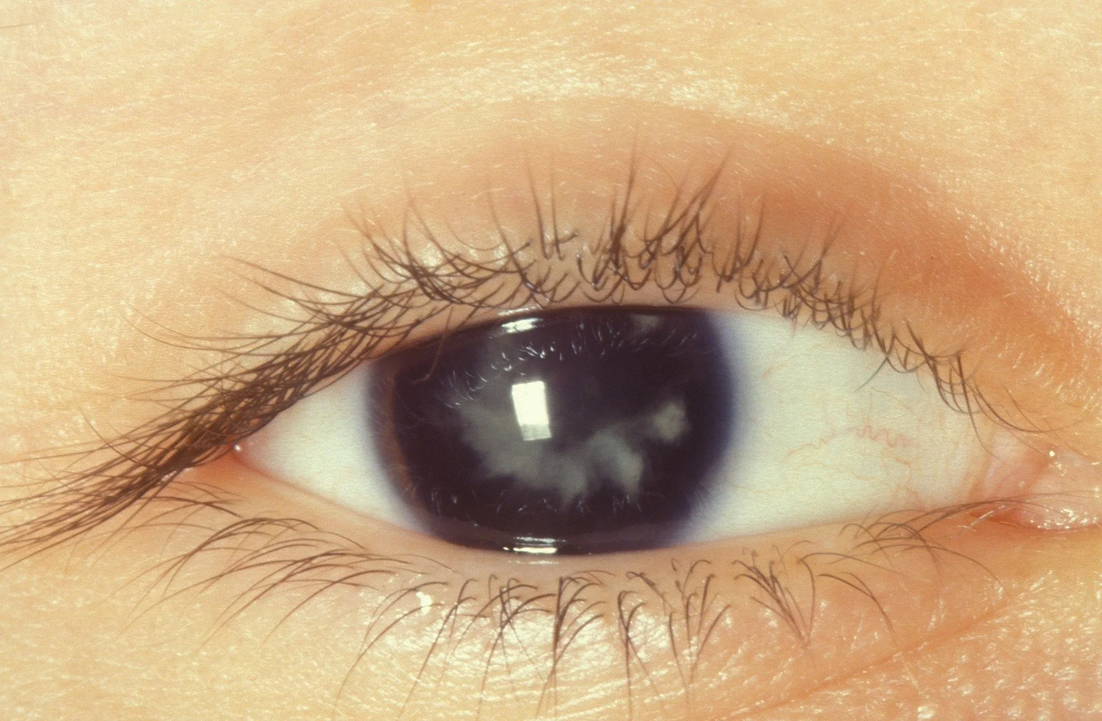 Types of cataracts
