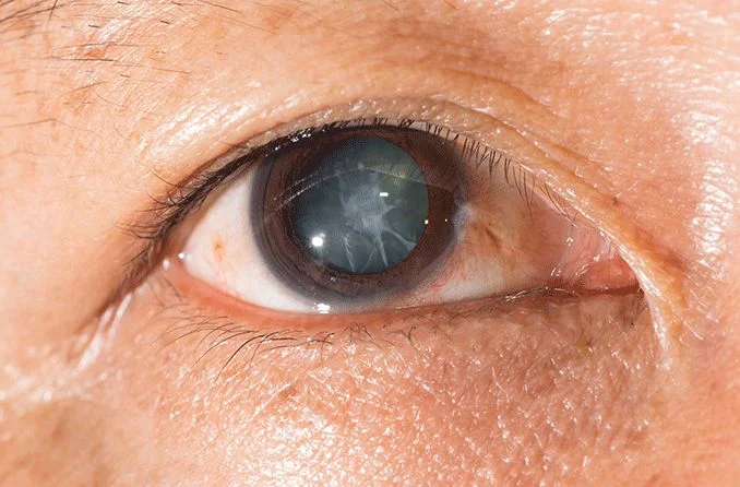 Cataract surgery Chandigarh